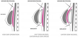 Brustimplantate in Brust