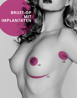 Brustimplantate Schnittführung